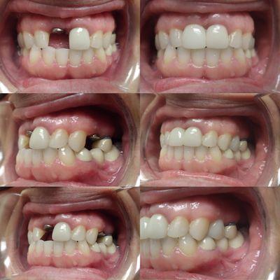 Our patient lost two teeth due to failed RCT.They were both nonrestorable. We placed both missing teeth with two beautiful implants.