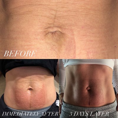 Before/After Plasma Lift Tummy Tightening