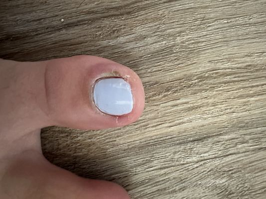 Day 6 of infected toe from this place.