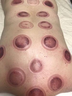 cupping