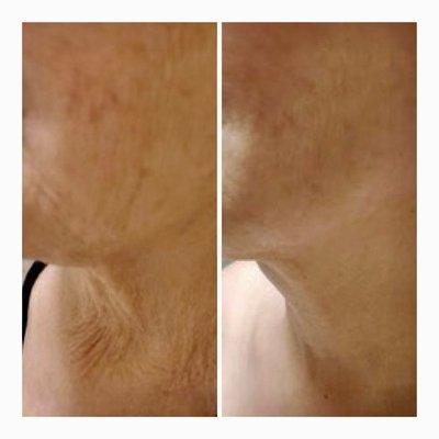 Neck Wrinkle Treatment - Before and After