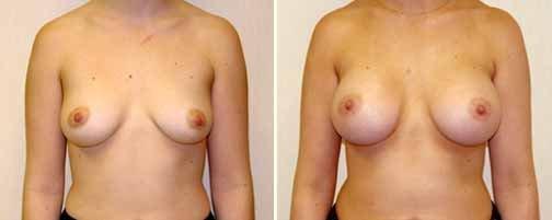 A young woman before and 2 months after a breast augmentation with silicone implants. 34B to C/D. $7650