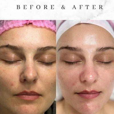 Deep pore facial