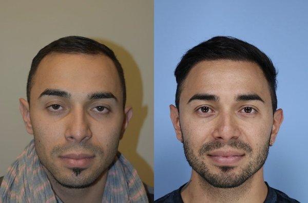 FUE Hair Restoration before and after