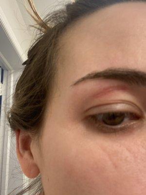 Painful eyelid