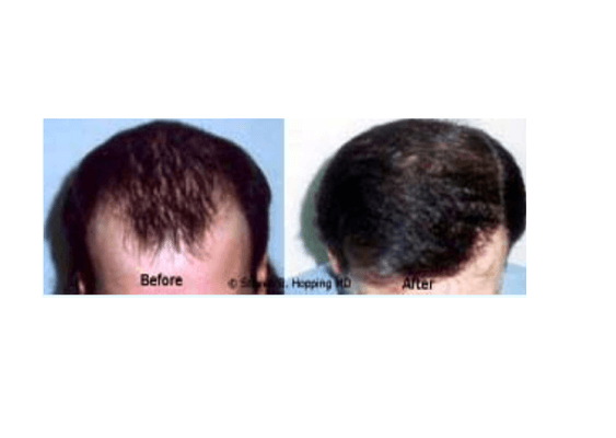 Hair Transplant