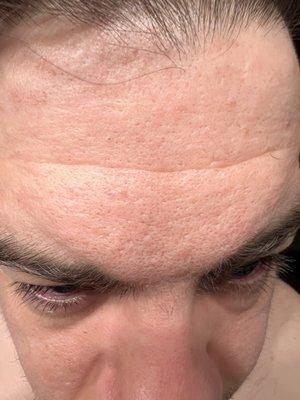 Damaged skin from RF Microneedling (Morpheus 8/Secret RF)