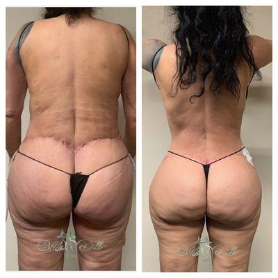 Lymphatic post op massage,  circular tummy tuck