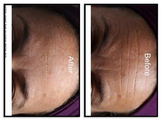 Reduce Wrinkles on the forehead