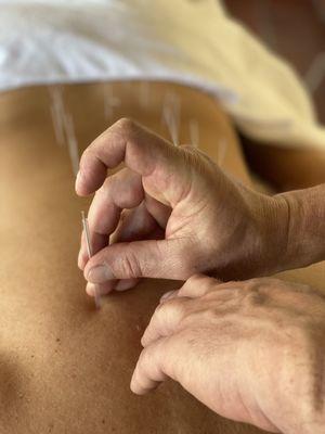 Acupuncture for back pain