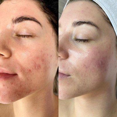 Acne peel after 1-2 treatments