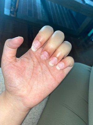 Destroyed finger nails