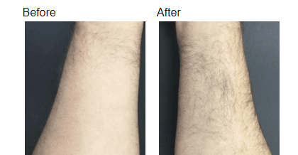 Laser hair removal Case #106 - Duo Light After 3 treatments Individual results may vary.