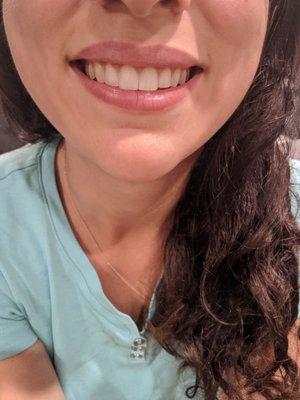 One year post op- gum didn't grow back down since doctor did an amazing job! Finally done with my aligners. Still loving my smile!