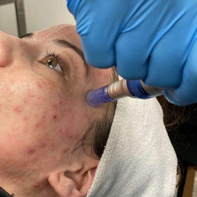 Microneedling