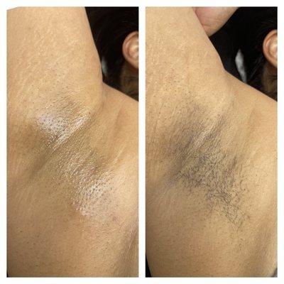 Underarm wax