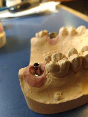 Custom Abutment