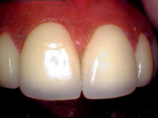 After Picture Anterior Crown - Same Day Crown!