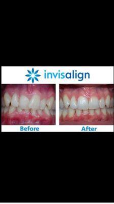 Dr. Mosleh completes Invisalign therapy to move orthodontically. She also completes Inman in adult patients who have relapsed.