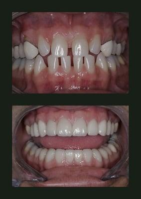 Full Mouth Reconstruction