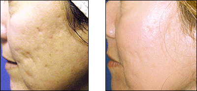 Fraxel Laser Treatment