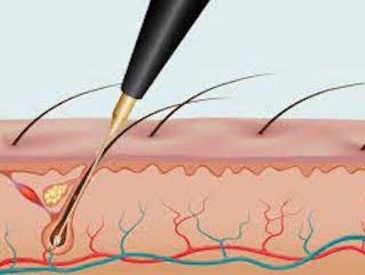 Electrolysis by Patty Jean