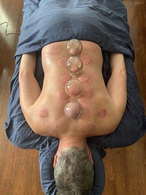 Cupping to surface and resolve stagnant blood. Great for the circulatory system!