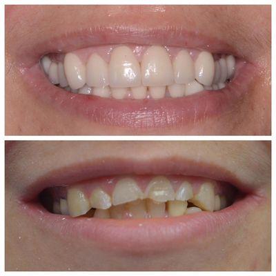 Before and After! This is our actual patient. Photo is shared with patient consent. - Jonathan Miller, DDS.