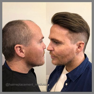 Same day results after our non surgical hair restoration