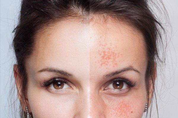 Perfect Derma Peel Before and After