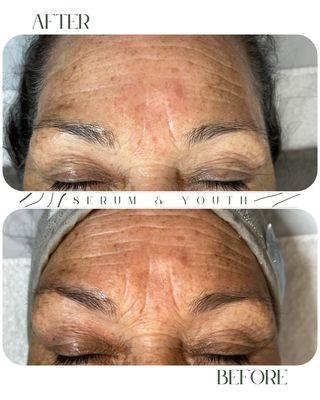 Anti-aging treatment