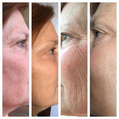 Dermapen Treatment Above results after 2 treatments!