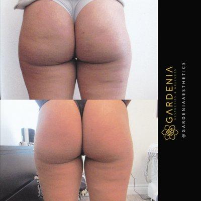 Before and after treatment on upper thighs and buttocks. Non-invasive treatment using ultrasonic cavitation to reduce cellulite and lift.