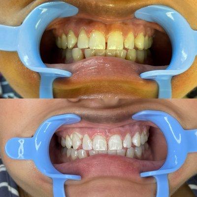 3 sessions of teeth whitening