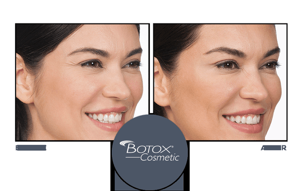 We offer Botox injections to help remove frown lines and wrinkles.