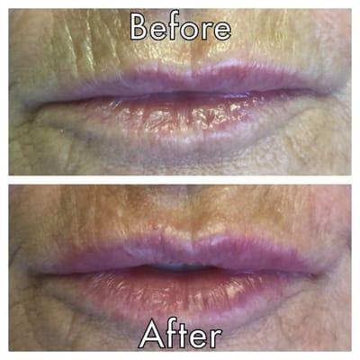 Lip filler before and after. Using Restylane Silk to smooth above lip lines. By Anne Swann, RN. Advanced Dermal Injector.