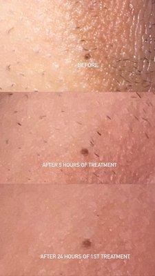 Skin Lightning Treatment