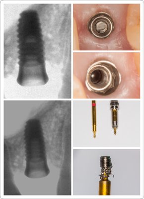 Remove broken screw from implant fixture