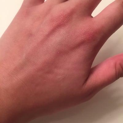 Signs of a reaction to the Orogold hand exfoliator and moisturizer