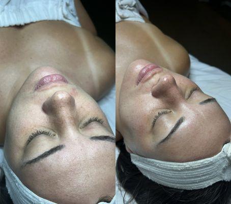 Before and after a dermaplaning facial!