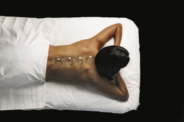 Cupping and gua sha (scrapping) are both used at Harmony + Health Acupuncture