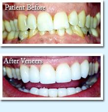 A satisfied St. Clair Shores patient before & after cosmetic dentistry using dental veneers.