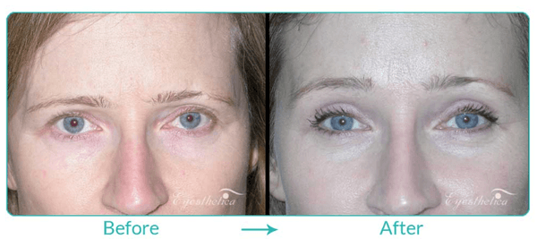 Before and After: Brow Lift by Dr. Steven C. Dresner