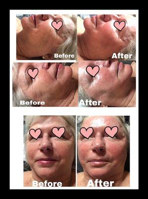 HydraFacial Before and After!