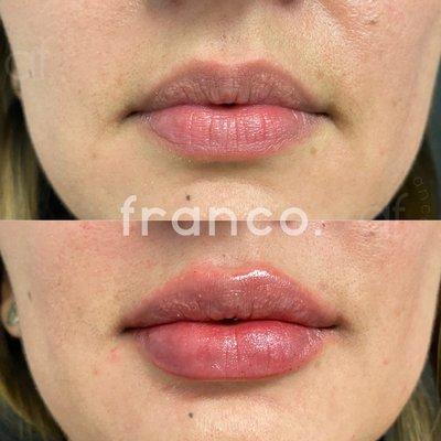 Beautiful Lip Filler