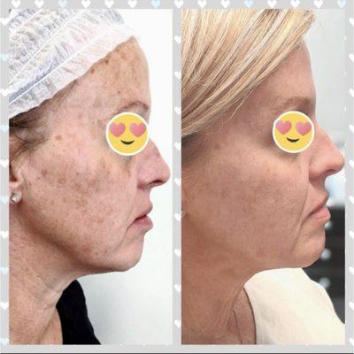 OPUS LASER RESURFACING! ONE SESSION