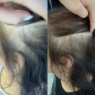 HAIR REGROWTH 4 sessions