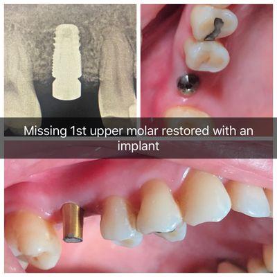 Most implant success is dependent on bone quality and quantity.