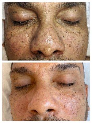 Before and after Microneedling 1 session.