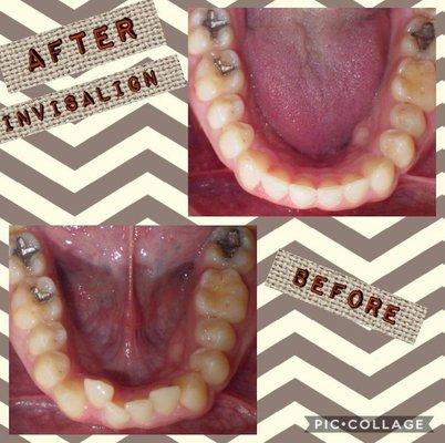 Invisalign Treatment